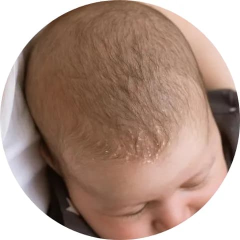 Removes cradle crap 