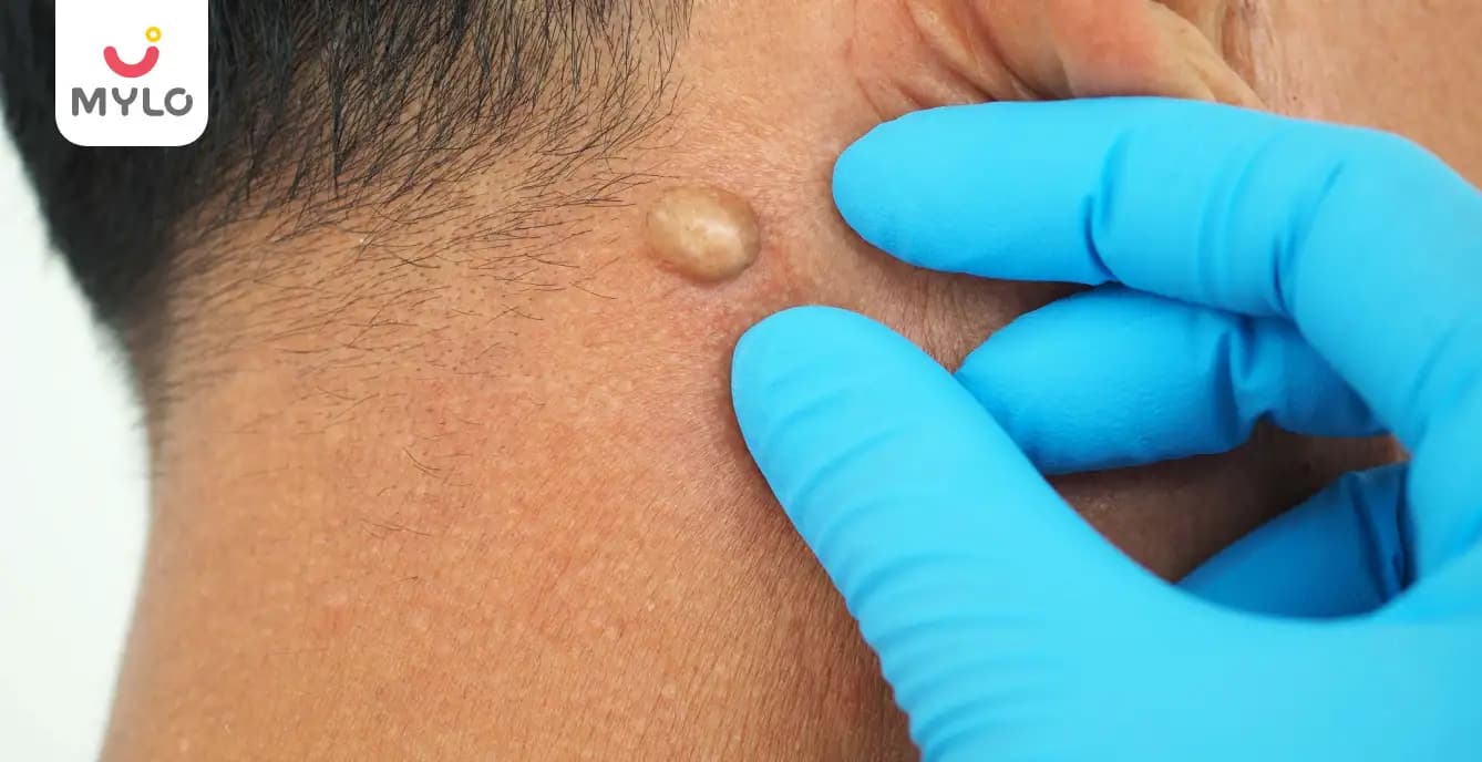 সাবেশাস সিস্ট - কারণ, লক্ষণ ও চিকিৎসা (Sebaceous Cyst - Causes, Symptoms & Treatment in Bengali)