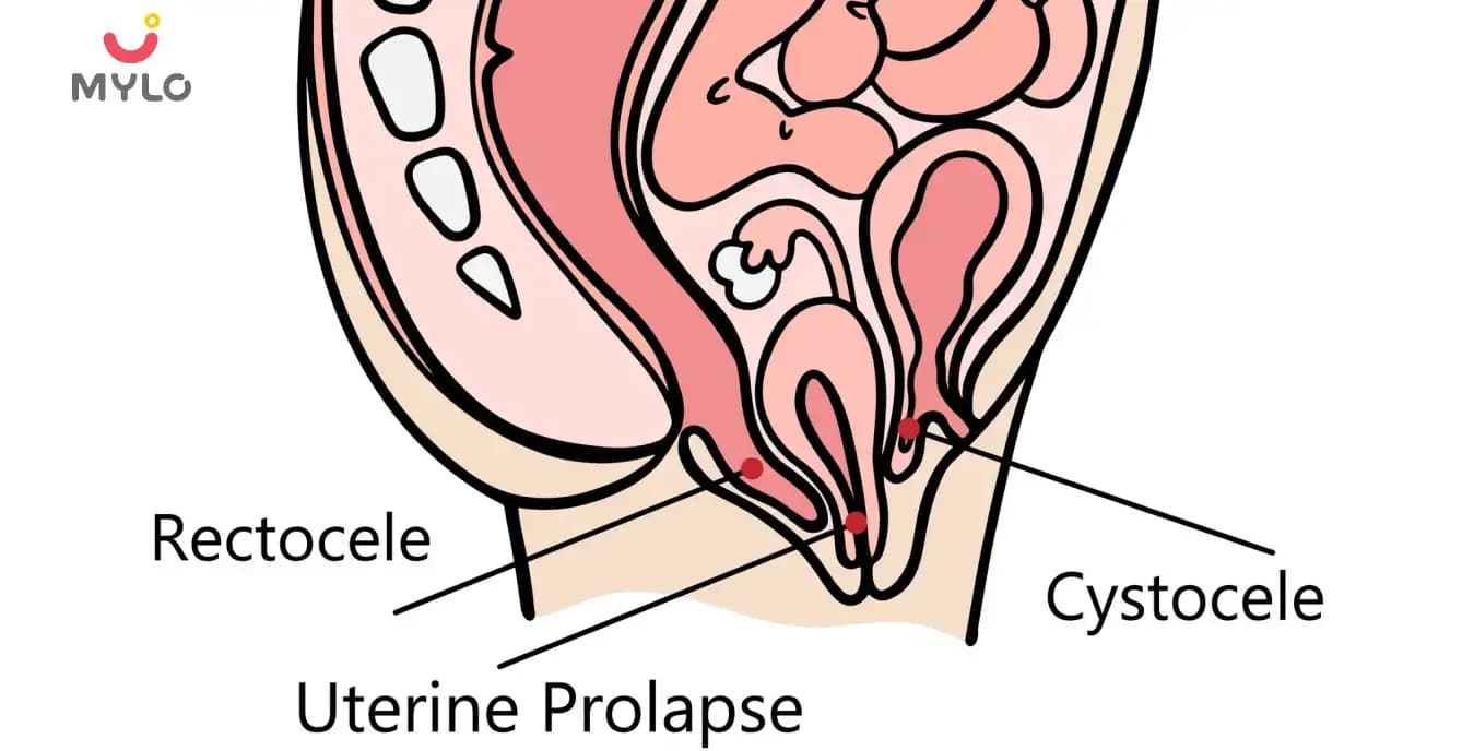 సిస్టోసెల్: కారణాలు, లక్షణాలు & చికిత్స  (What is Cystocele : Reason and Treatment in Telugu)