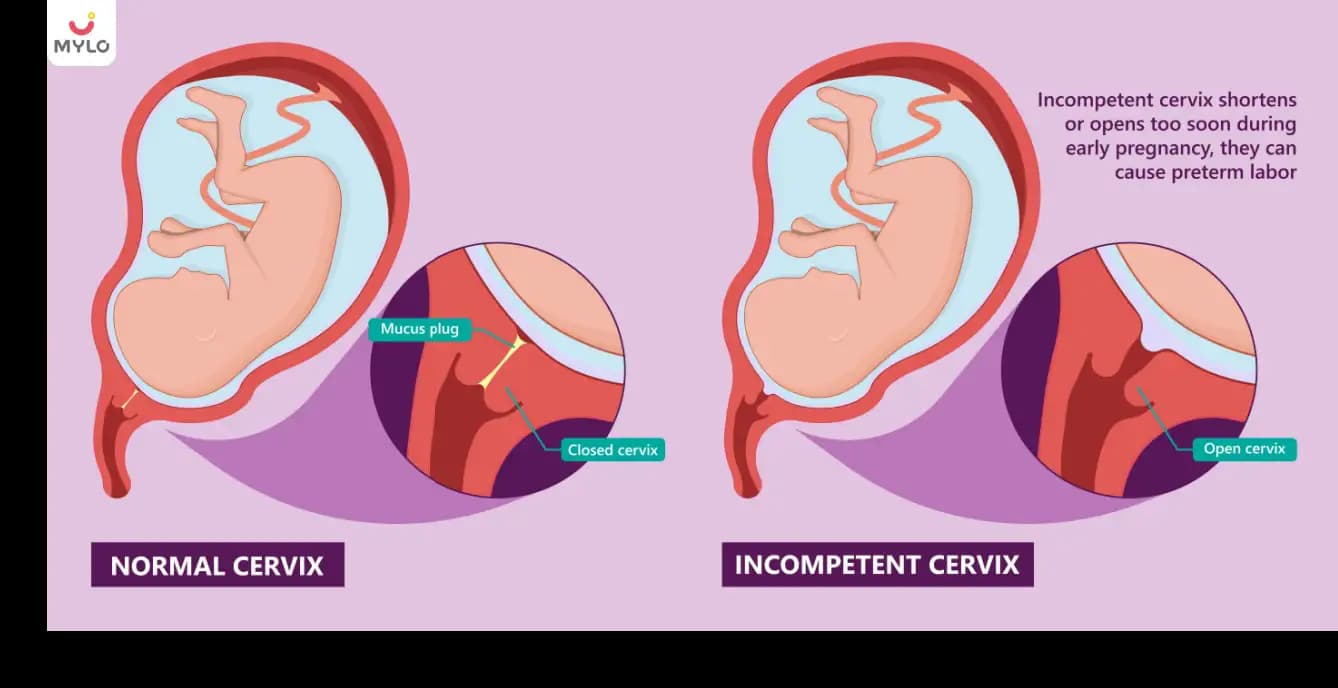 Incompetent Cervix (Cervical Insufficiency): Causes, Symptoms, Treatment and Recovery Guide (2026)