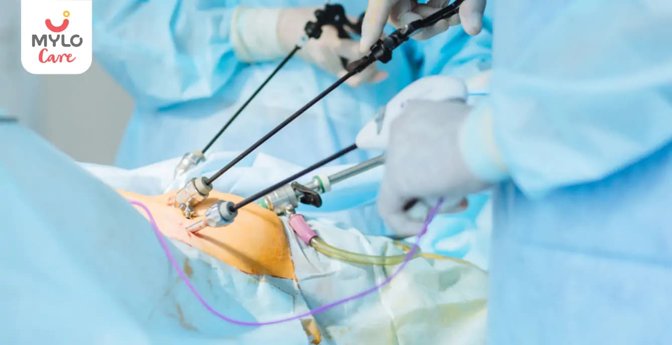 Laparoscopic Ovarian Drilling: A Safe and Effective Solution for PCOS-Related Infertility  