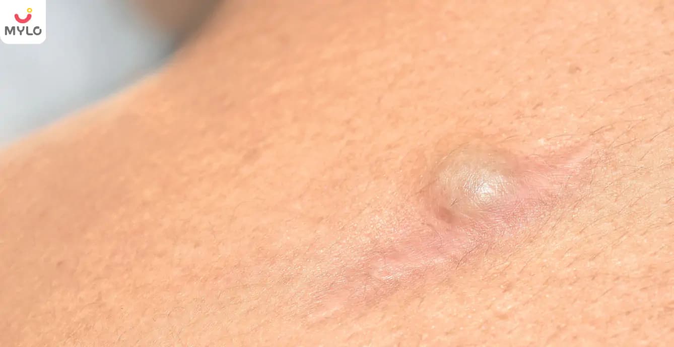 Pilonidal Cyst in Hindi | पिलोनाइडल सिस्ट क्या है? जानें इसके कारण और लक्षण