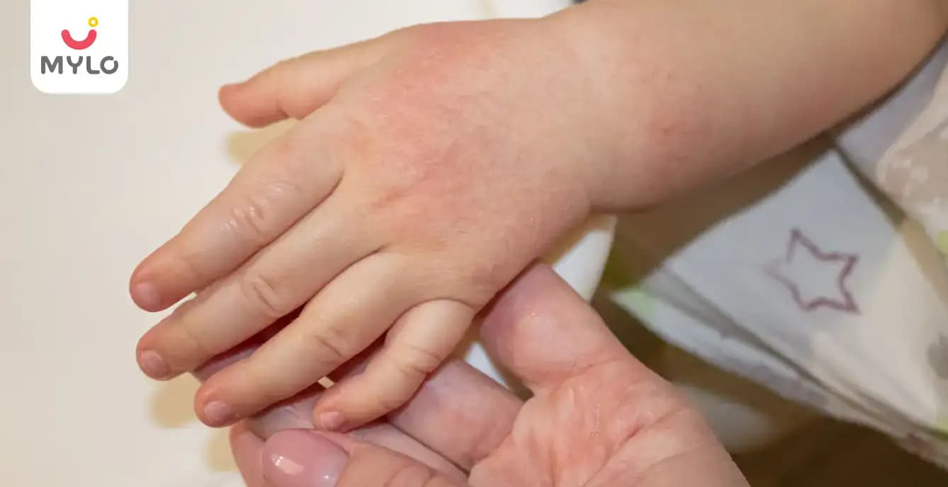 Kawasaki Disease: Meaning, Symptoms & Treatment