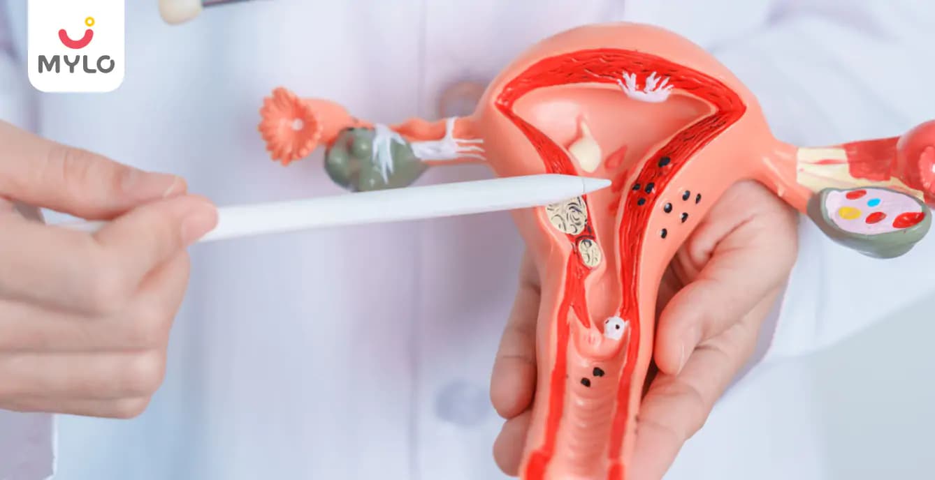 Endometrial Polyp and Pregnancy: How Uterine Polyps Can Affect Your Chances of Conception