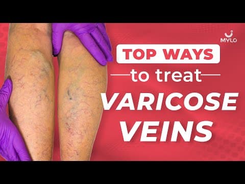 Ways To Get Rid Of Varicose Veins | Treatment For Varicose Veins | Symptoms Of Varicose Veins