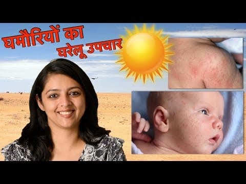 Heat Rashes Home Remedies
