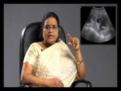 Down's Syndrome Test in Pregnancy- By Dr. Balakumari