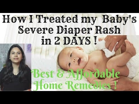 Watch this video on How I treated my baby's diaper rash in just 2 days.
home remedies and best tips and tricks to avoid rashes !
Also there is a free GIVEAWAY do participate in it and win awesome goodies..?
subscribe to my channel and press the bell icon for more ?