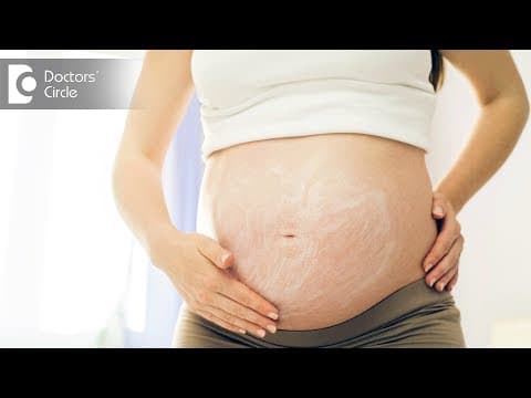 How to manage stretch marks post delivery? - Dr. Shefali Tyagi