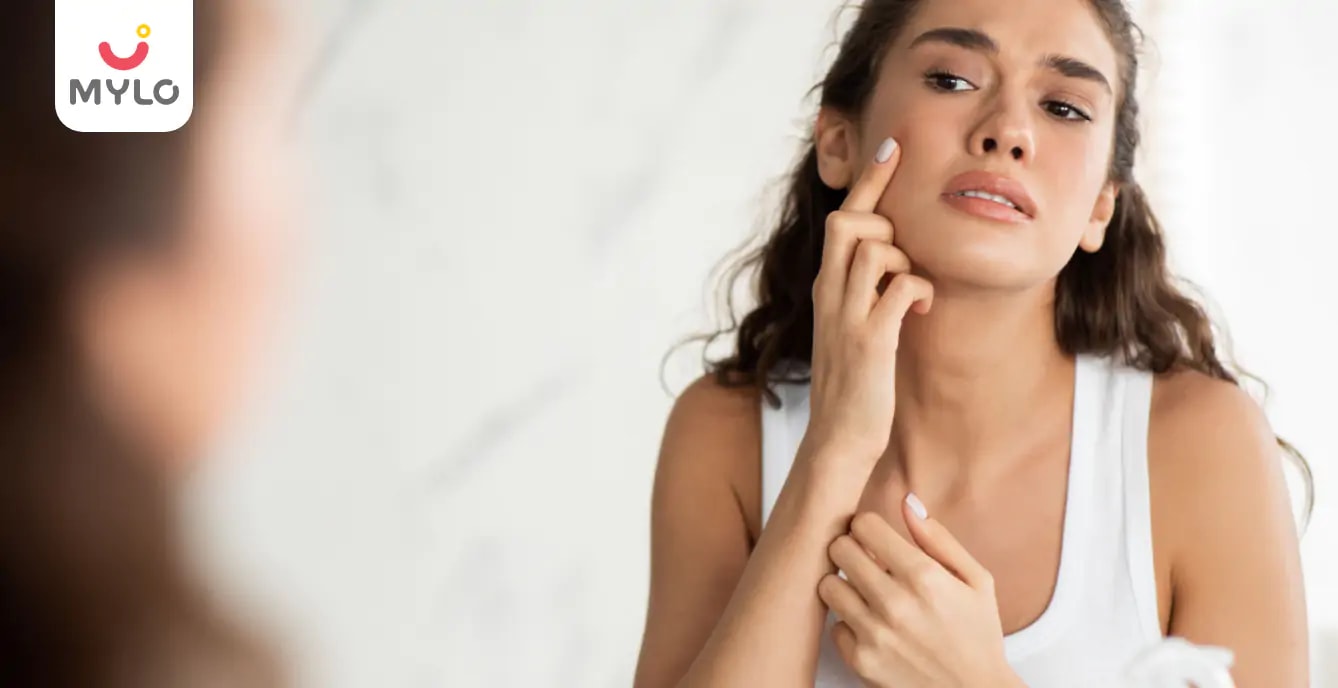 Causes of Acne in Hindi | आख़िर क्यों होते हैं एक्ने?