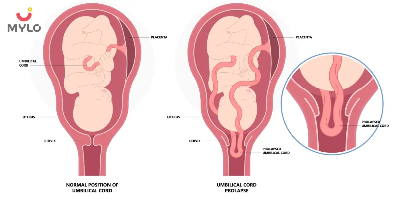 Umbilical Cord Prolapse Causes, Symptoms & Treatment