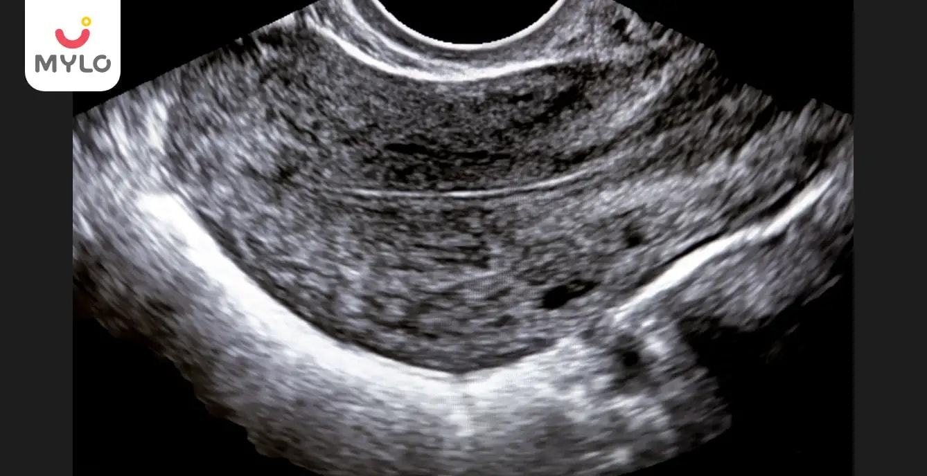 The Significance of Trilaminar Endometrium in Fertility: What You Need to Know