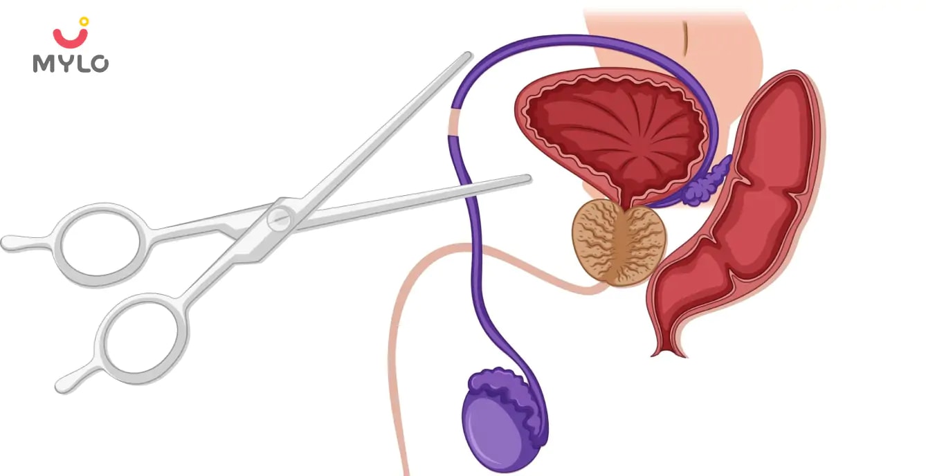 Vasectomy Reversal: Meaning and Risks