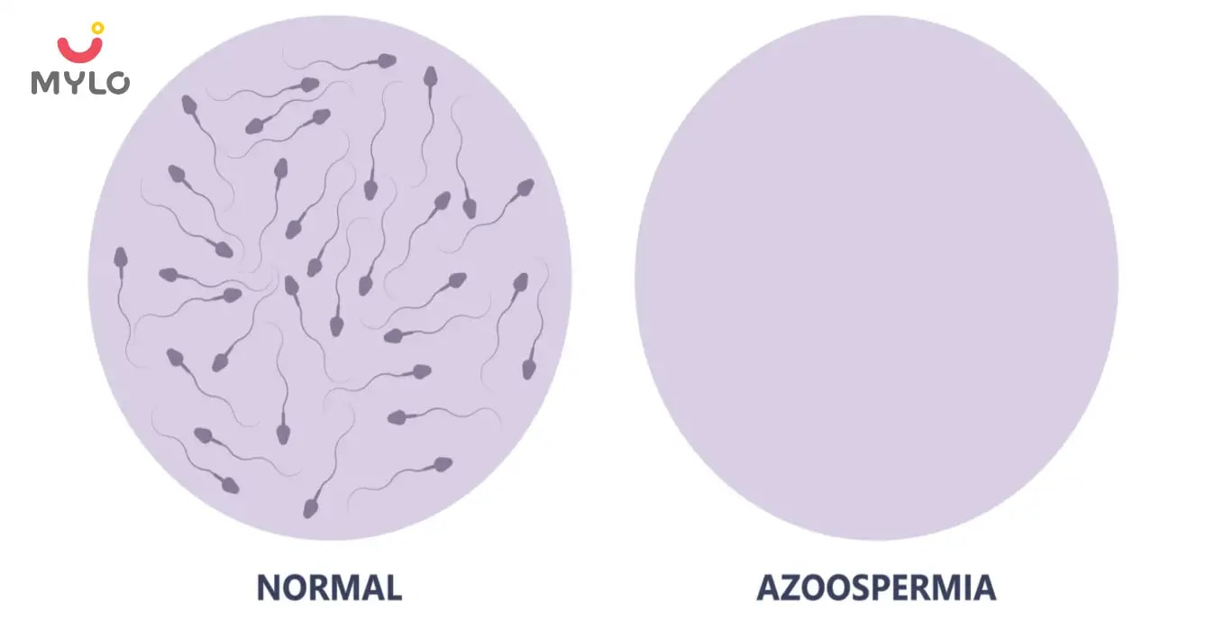 Azoospermia Meaning in Hindi | पुरुषों से पिता बनने का सुख छीन सकता है एजुस्पर्मिया!  