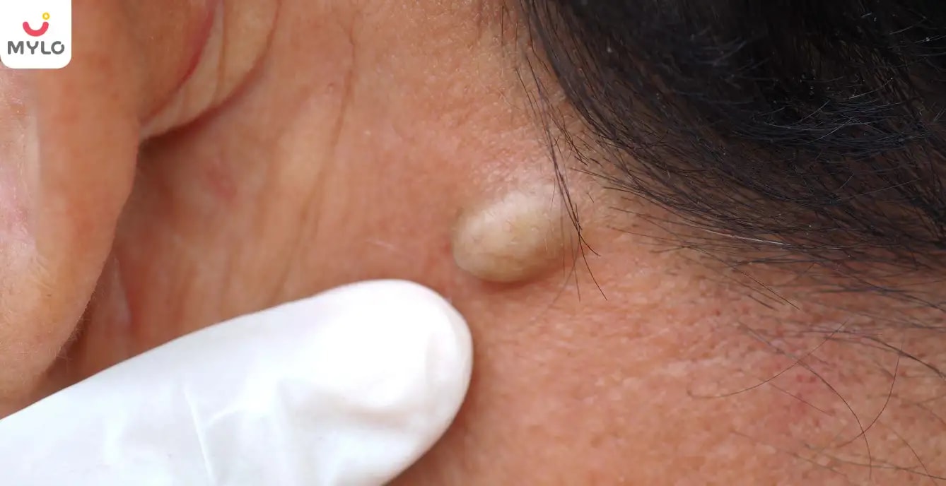 Sebaceous Cyst in Hindi | सिबेसियस सिस्ट क्या है? जानें इसके लक्षण