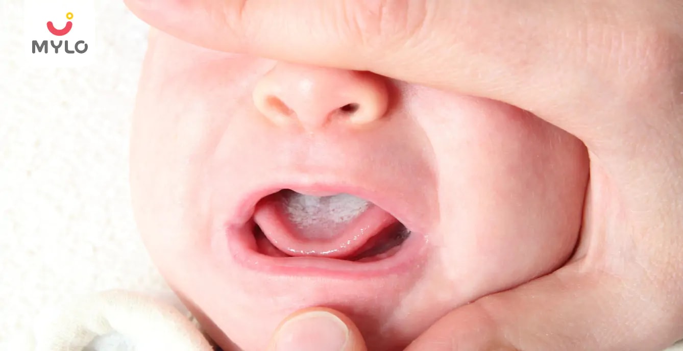Baby's Mouth Thrush (Oral Thrush in Babies): Symptoms, Causes, Treatment and Home Care Guide (2026)