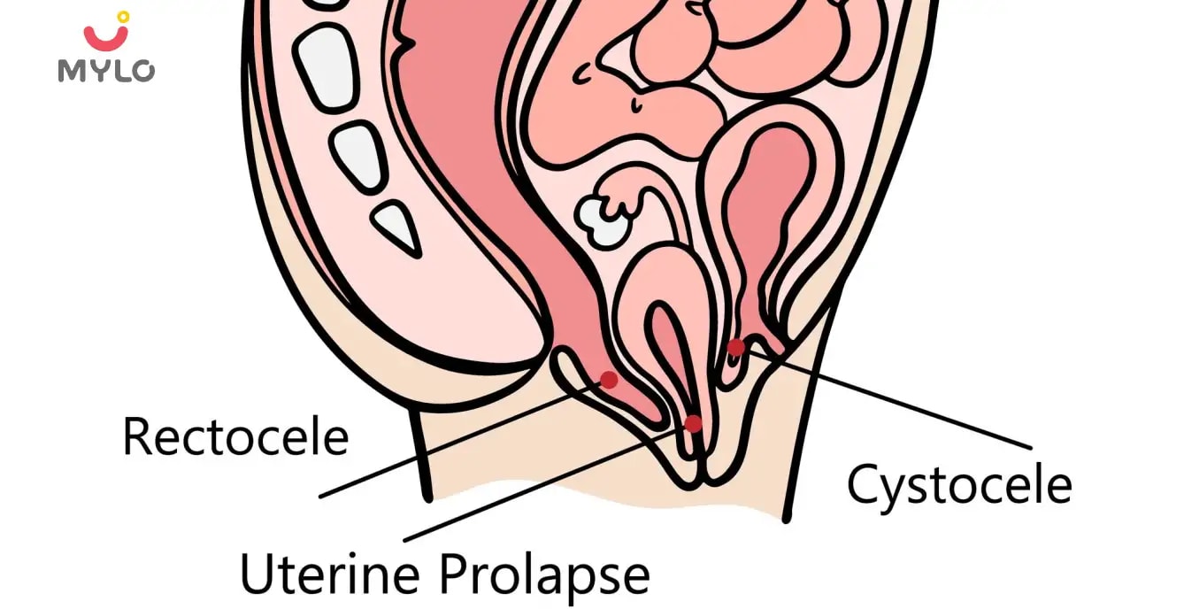 Cystocele: Causes, Symptoms & Treatment 