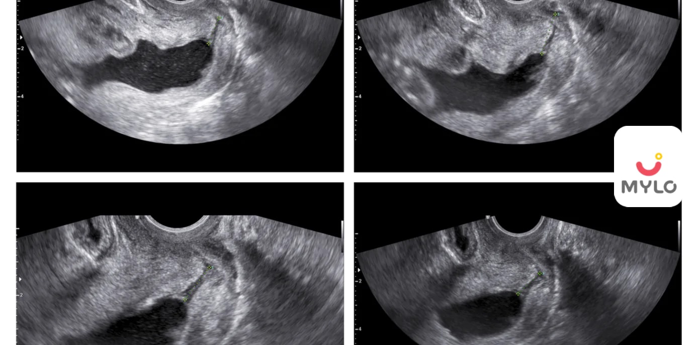 Anomaly Scan: The Ultimate Guide for Expecting Parents