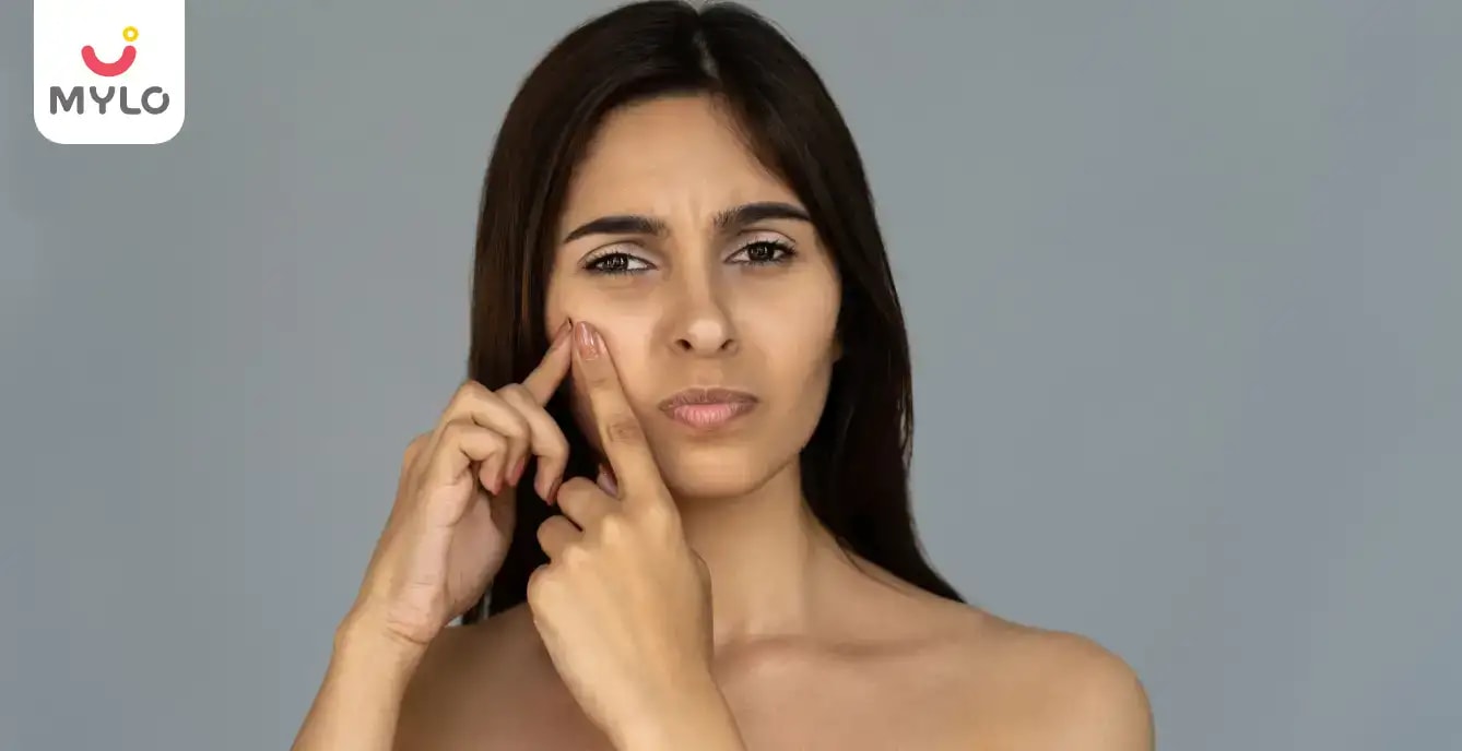 Top 5 Natural Ways to Get Rid of Acne from the Skin