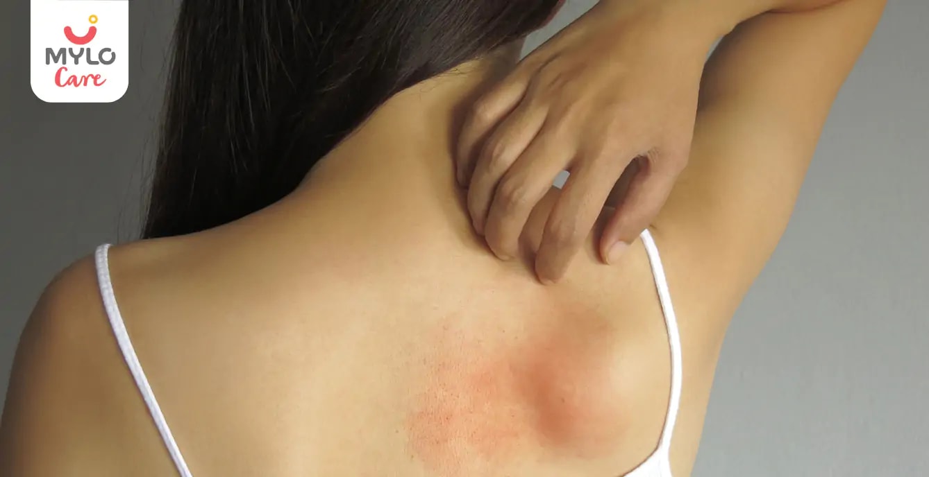 Heat Rash During Pregnancy: Causes, Symptoms and Prevention