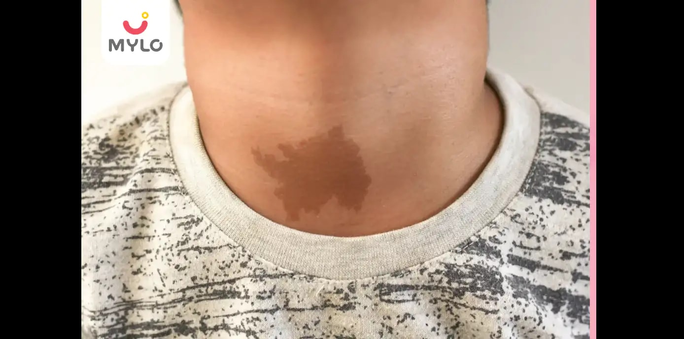 Birthmark: Types, Causes, Risks & Treatment