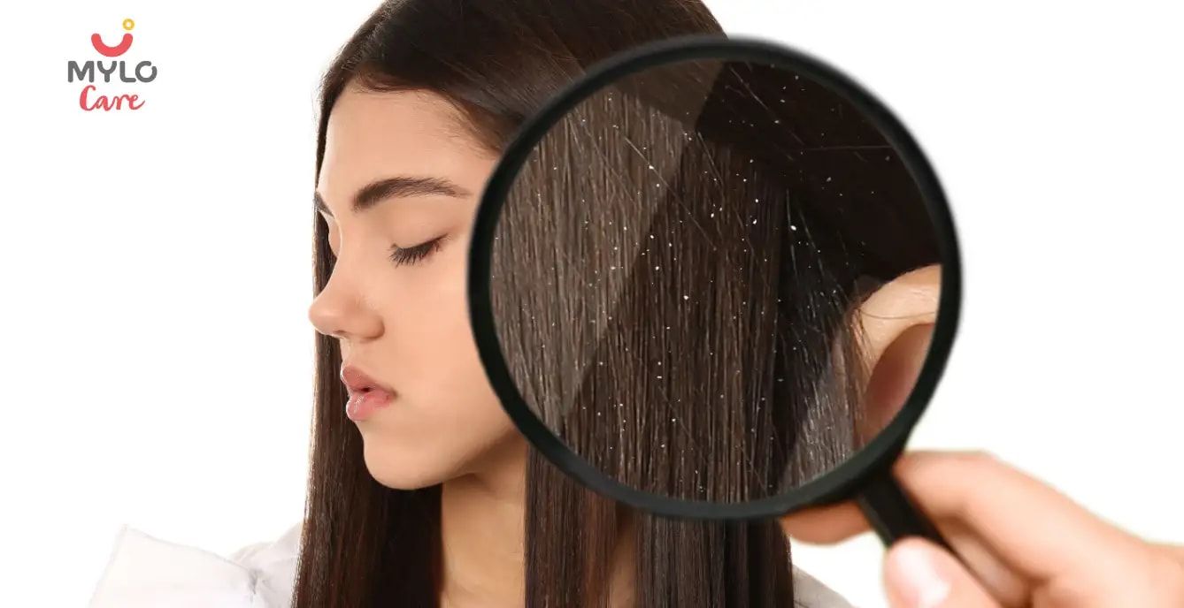  Dandruff Solution in Hindi | डैंड्रफ की समस्या? ये उपाय आएँगे आपके काम! 