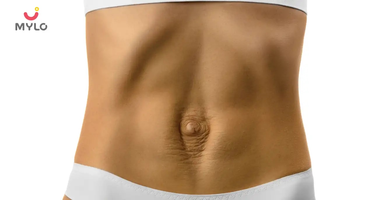 Diastasis Recti: Causes, Symptoms, Risks & Preventions