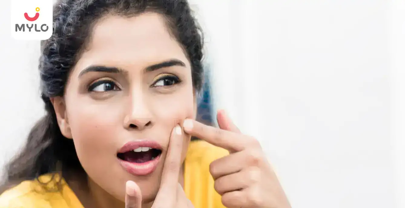 మీ చర్మం మీద మొటిమలను వదిలించుకునేందుకు టాప్ 5 సహజ మార్గాలు