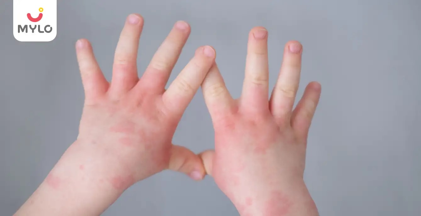 CMPA (Cow's Milk Protein Allergy): Identifying Symptoms and Understanding Treatment