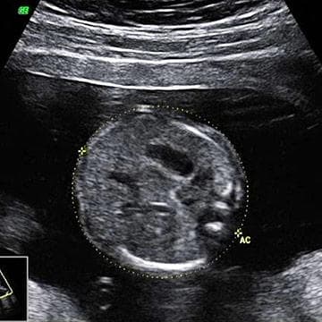 Your Ultrasound in Week 18