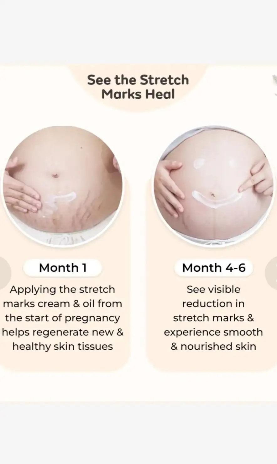 Stretch Marks Kit - Removes Scars | Made with Natural Ingredients | Tightens Skin - (Stretch Mark Oil - 100 ml, Stretch Marks Cream - 100ml)